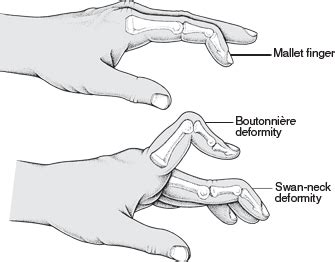 Hand Deformities | Plastic Surgery - Thumbay University Hospital