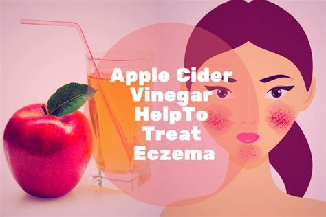 Apple Cider Vinegar for Eczema - How To Use It [GUIDE]