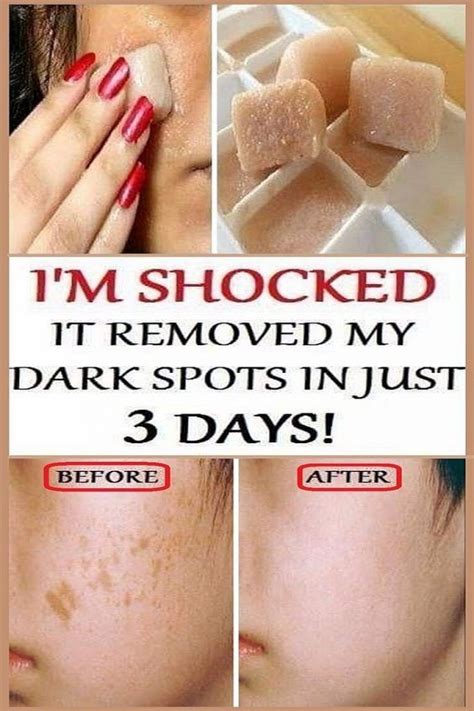 I’m SHOCKED It Removed My Dark Spots In 3 Days, Magic Remedy | Healthy ...