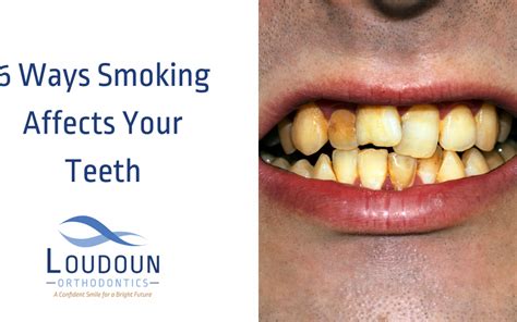 Six Ways Smoking Teeth Damage Happens