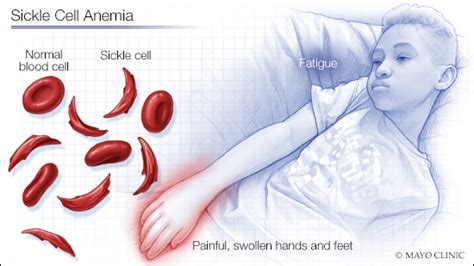 Sickle cell anemia is an inherited form of anemia - Mayo Clinic News ...