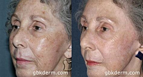 Age Spots: Causes, Risk Factors, and Treatment Options: Essence Medispa ...