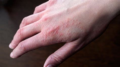 Can Dogs Get Eczema From Humans