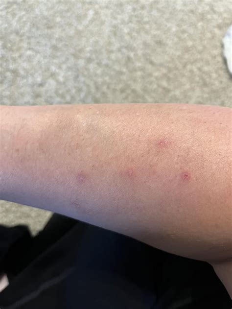 Weird Small Sores on Arms : r/lupus