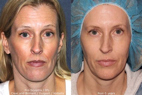 Clear + Brilliant Laser Resurfacing | San Diego, CA | CLDerm