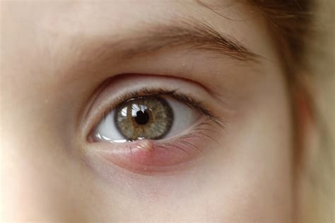 What is a stye and how do you treat it? - Qoctor your quick online doctor