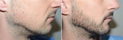 Minoxidil Before And After Beard