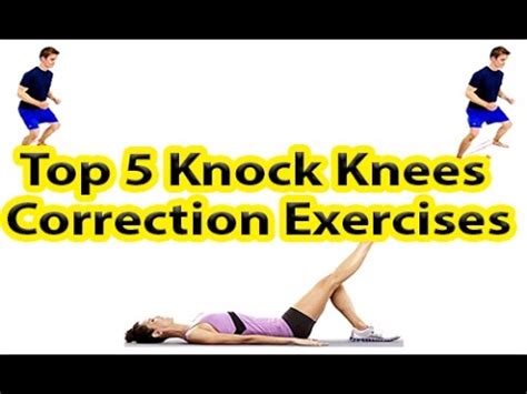 Top 5 Knock Knees Correction Exercises - YouTube