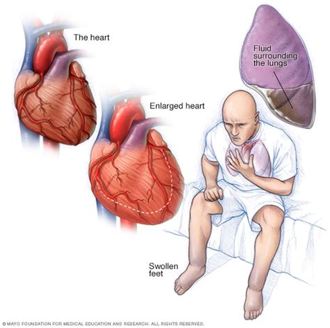 Heart failure - Mayo Clinic