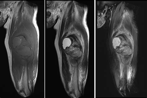 Extraskeletal osteosarcoma – Radiology Cases