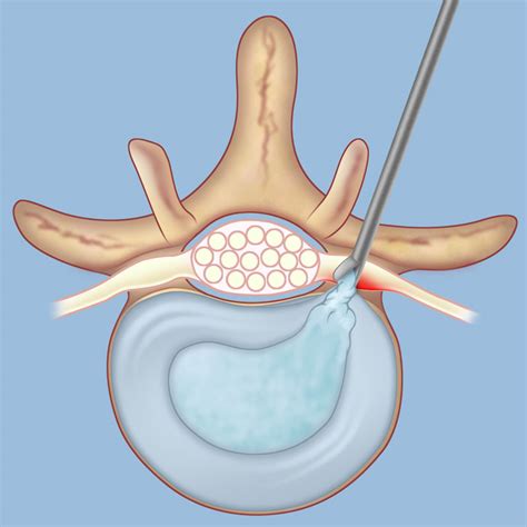 Microdiscectomy - ONZ Spine