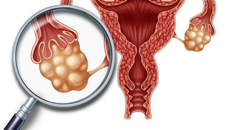 Síndrome del ovario poliquístico: Síntomas y causas