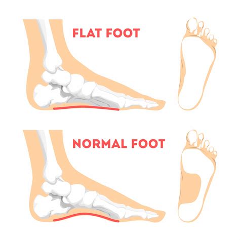 Ankle Sprains Situations With Inversion And Eversion Injury Outline ...