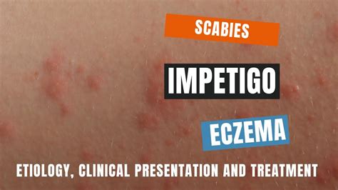 Pathophysiology Of Scabies