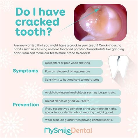 Do I have cracked tooth? - MySmile Dental Clinic