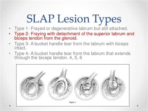 Slap Lesion Types