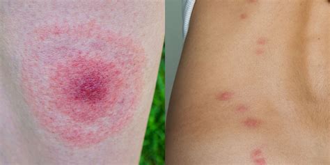 12 Common Bug Bite Pictures - How to ID Insect Bites and Stings