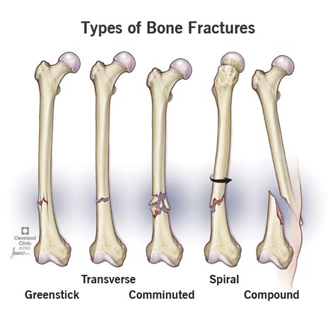 Bone Fractures: Types, Symptoms & Treatment