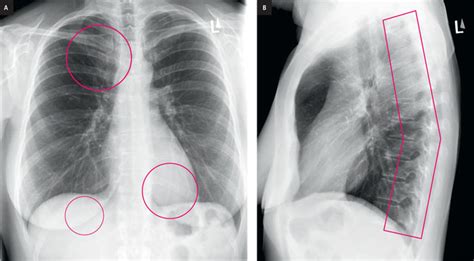 64-year-old male patient with central chronic worsening chest pain ...