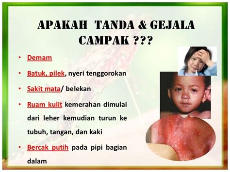 Penyakit campak measles