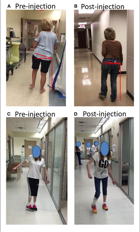 Figure 2 from Post-stroke Hemiplegic Gait: New Perspective and Insights ...