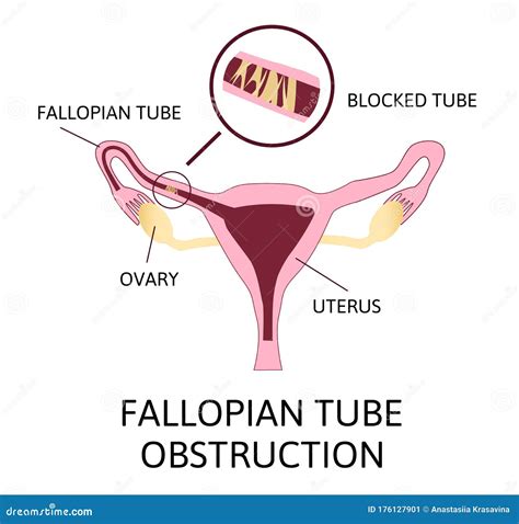 Fallopian Tubes Diagram