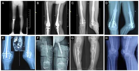 Osteosarcoma Symptoms