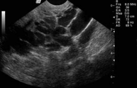 Pelvic Congestion Syndrome Ultrasound - Captions Hunter