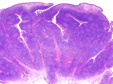 Pharyngeal Tonsil Histology