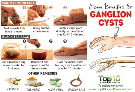 How To Pop Ganglion Cyst - Pop Cyst.Remove Cyst.Part 1,Quack Doctor ...