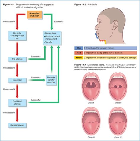 Lemon Mnemonic For Difficult Airway