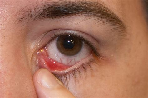 Eye Stye - Causes, Symptoms, Treatment, Pictures | Stye Eye | Stye in ...