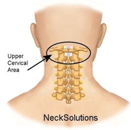 Rheumatoid Arthritis Neck