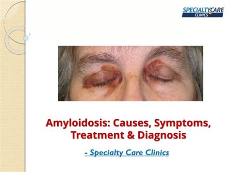 PPT - Amyloidosis - Causes, Symptoms, Treatment & Diagnosis PowerPoint ...