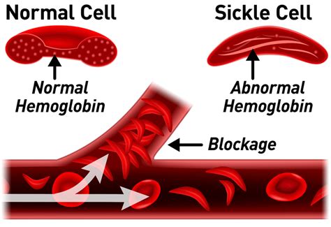 World Sickle Cell Day: Causes, Symptoms And Treatment - Kuulpeeps ...