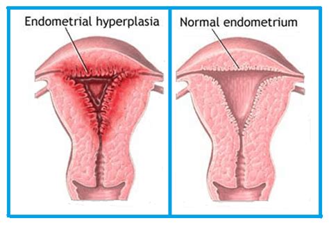 Endometrial Hyperplasia | Menopausal Issues | Best Gynaecologist in ...