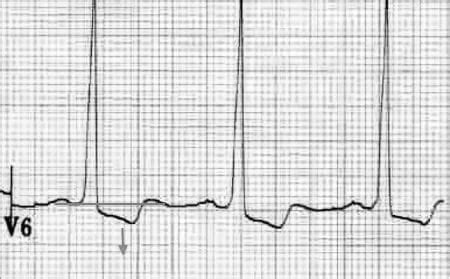 Left Ventricular Hypertrophy (LVH) • LITFL • ECG Library Diagnosis