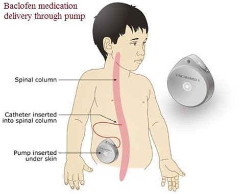 Pump: Baclofen Pump