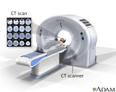 Head CT scan Information | Mount Sinai - New York