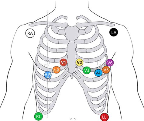 ECG Lead Placement - Cardiology Fellowship - Pediatric Fellowships ...