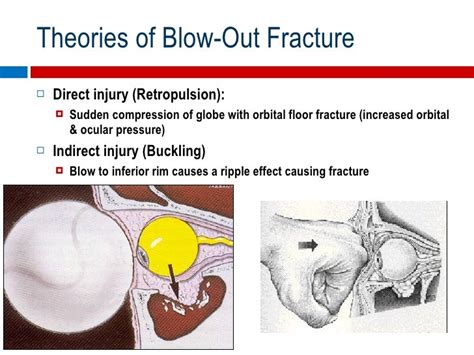 Orbital Floor Fracture Causes | Review Home Co