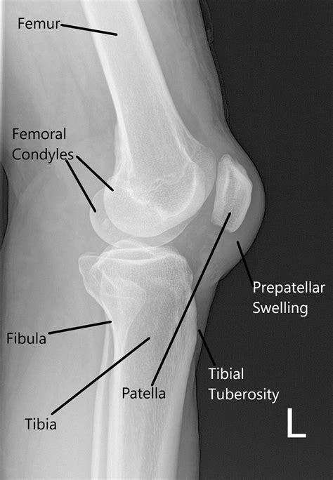 Case Study: Left Knee Tear Management in 55 yr. Old Female