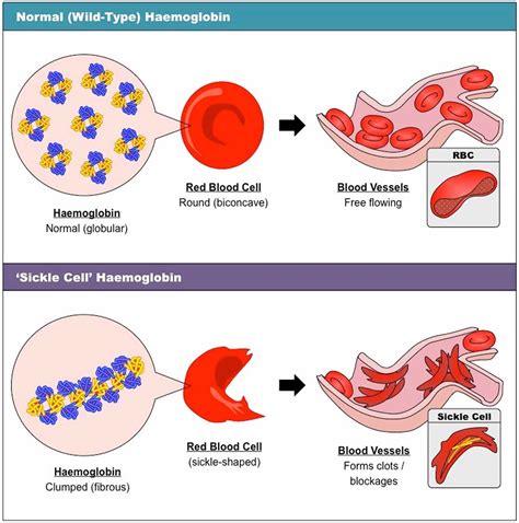 Sickle cell disease, causes, fenetics, symptoms, diagnosis, treatment ...