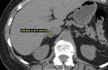 Adrenal Gland | Radiology Key