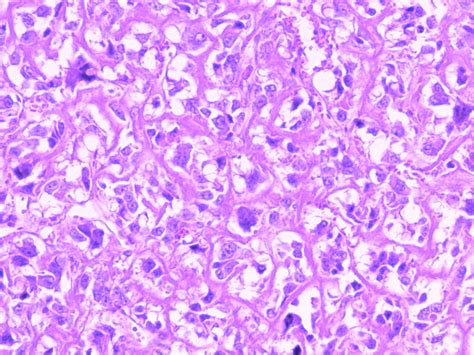 Osteosarcoma Jaw Histology