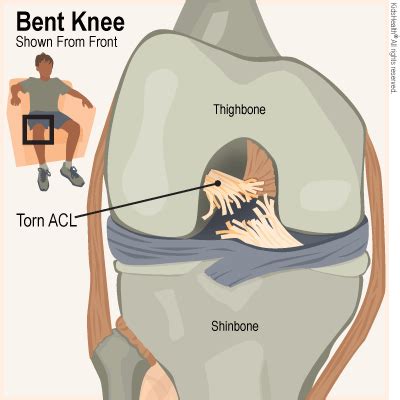 Anterior Cruciate Ligament (ACL) Tears (for Parents) | Nemours KidsHealth