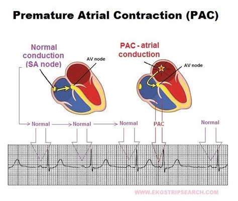 Premature Ventricular Contractions Causes