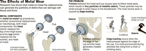 DePuy Orthopaedics Hip Implant Recalled Due to Metal Complications