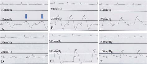 Intracardiac pressure waveform with a Swan-Ganz catheter; (A) the right ...