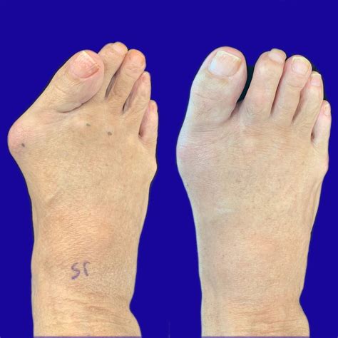 Before and After Bunion Surgery Photos | Northwest Surgery Center